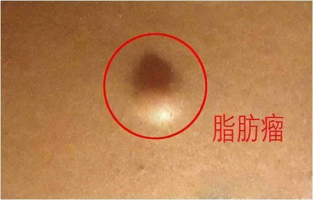 這3種瘤都是良性病變，醫(yī)生提醒：一旦查出來，不必自己嚇自己