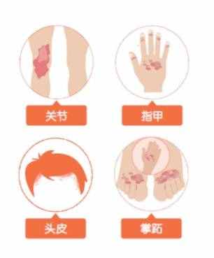 叫癬不是“癬”，細(xì)數(shù)牛皮癬的那些事