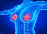 今日更新乳腺增生怎么辦(乳腺增生自己如何調(diào)理)