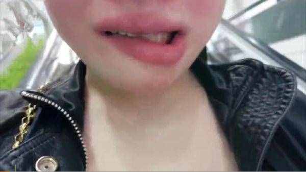 24歲女孩花4萬元整容下頜手術變歪嘴，哭訴我還沒有結(jié)婚呢