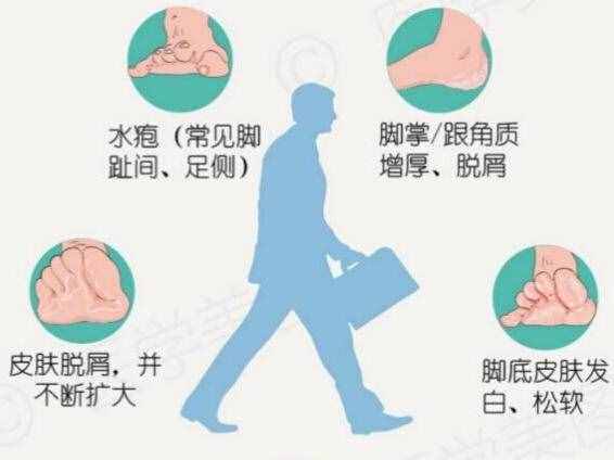 夏季是“香港腳”頻發(fā)季，醫(yī)生：家庭用醋泡腳達(dá)不到殺菌效果，30%的醫(yī)用冰醋酸才有效