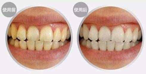 檸檬汁不僅能美白皮膚，還能美白牙齒？