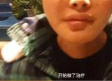 今日更新下巴整形手術(shù)多少錢（24歲女孩花4萬元整容下頜手術(shù)）