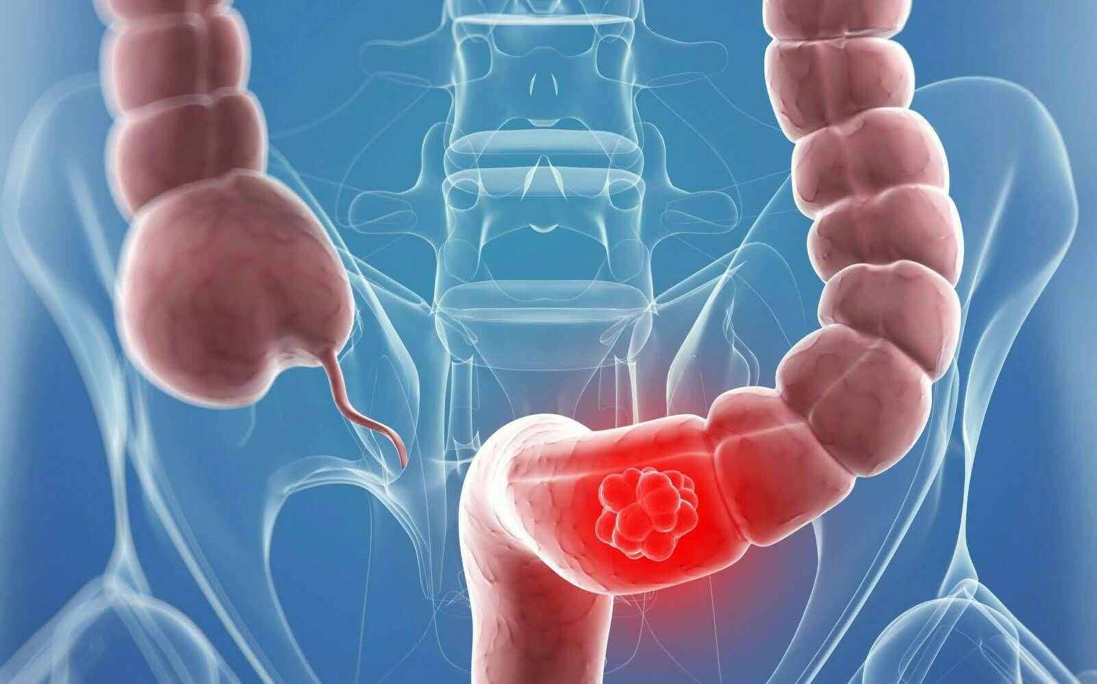 腸癌不痛不癢，出現(xiàn)這4個癥狀，是腸癌發(fā)出的信號，別忽視