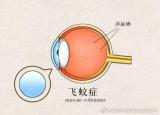 今日更新飛蚊癥怎么治療恢復(fù)(高度近視飛蚊癥要緊嗎)