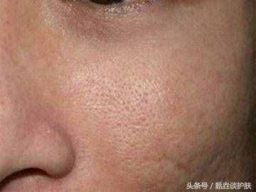 “毛孔粗大”的真正原因，您可能想不到？