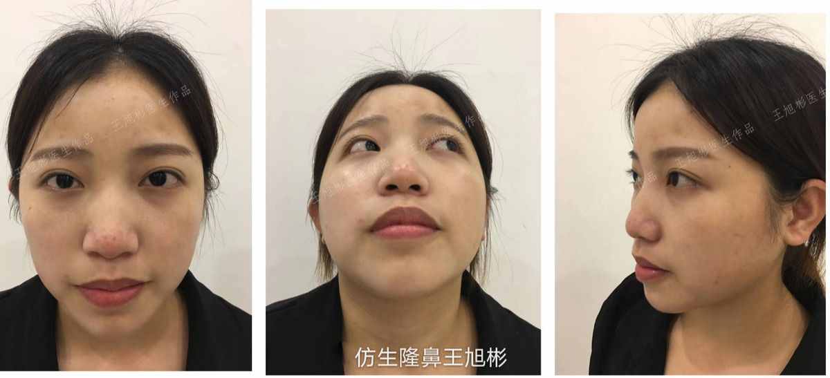 鼻頭肥塌大，如何逆襲成自然小秀挺？王旭彬仿生鼻尖整形案例