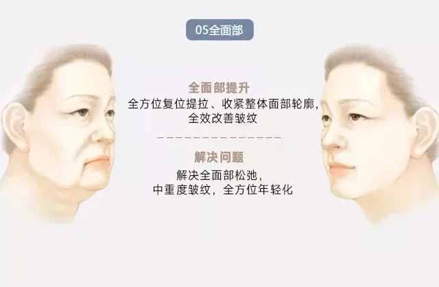 面部年輕化可以改善哪些方面？