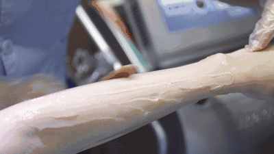 10分鐘永久全身脫毛，給你一個(gè)滑溜溜的夏天