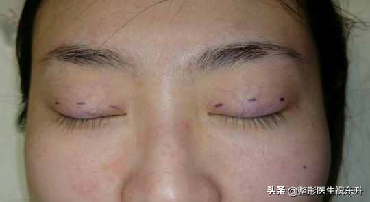 什么是三點式雙眼皮？有什么特點？