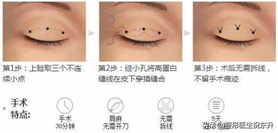 什么是三點式雙眼皮？有什么特點？