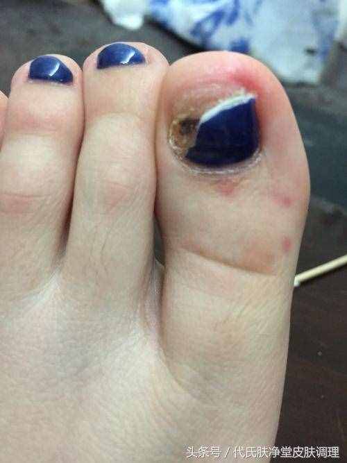 五塊錢的小偏方還您亮白指甲！灰指甲什么的根本不在話下！