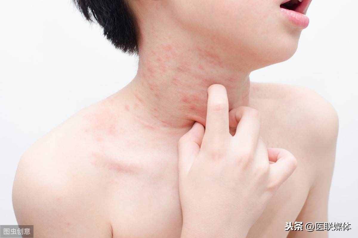 皮膚過(guò)敏會(huì)出現(xiàn)哪些癥狀？醫(yī)生：多有這一表現(xiàn)，得學(xué)會(huì)辨別