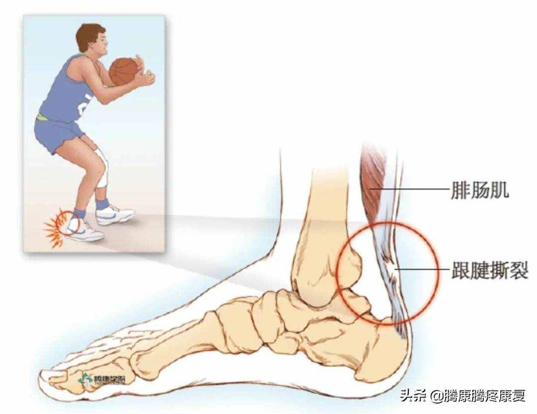 跟腱炎的分析與診療
