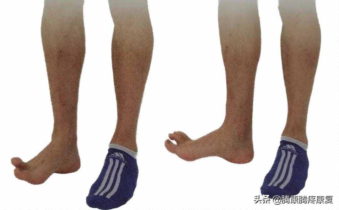 跟腱炎的分析與診療