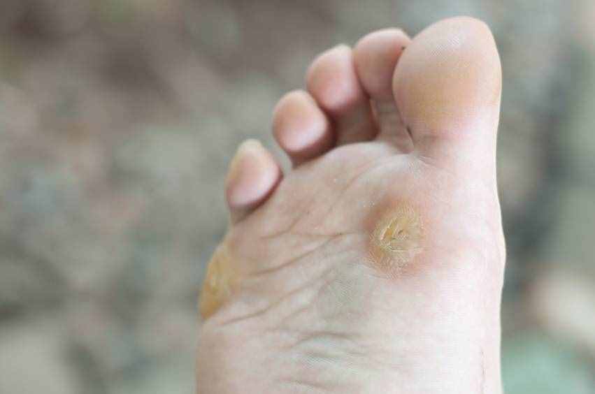 皮膚科醫(yī)生：腳趾甲變厚，是什么原因？