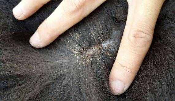 頭上長虱子怎么去除 去虱子和虱子卵的有效方法