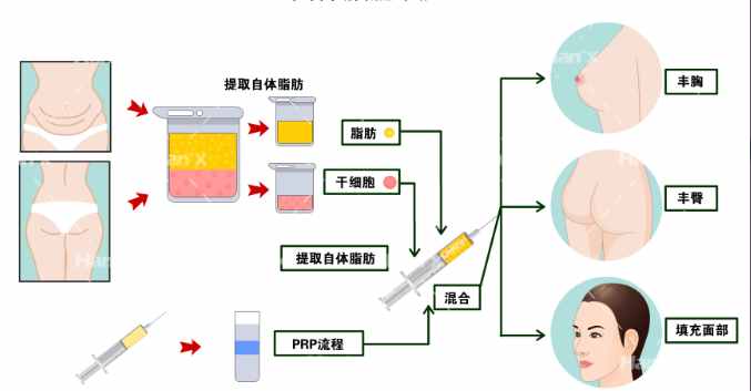 芒果吸脂手術(shù)的安全性怎么樣？