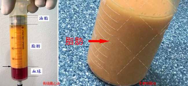 芒果吸脂手術(shù)的安全性怎么樣？