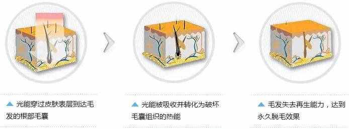 10分鐘永久全身脫毛，給你一個滑溜溜的夏天