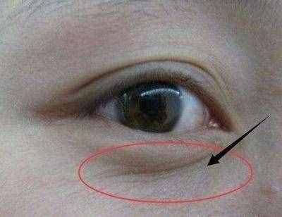 迪麗熱巴都消不掉的眼紋，你想靠眼霜和按摩就消掉？