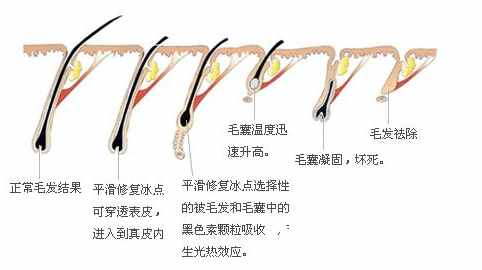冰點(diǎn)脫毛原理圖解