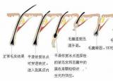 今日更新冰點脫毛多少錢（冰點脫毛有用嗎）