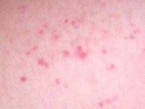 剛感染艾滋病毒（HIV）有哪些癥狀？潛伏期有多長時間