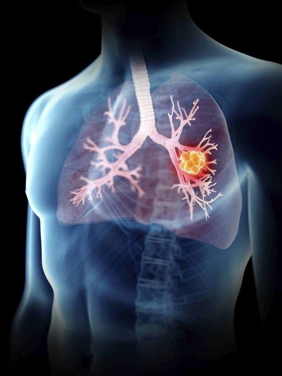 「科普」肺癌會傳染嗎？不一定！我來幫大家分析分析