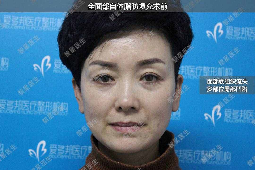 面部凹陷，皮膚松弛，像顆缺水的葡萄干，怎么辦？