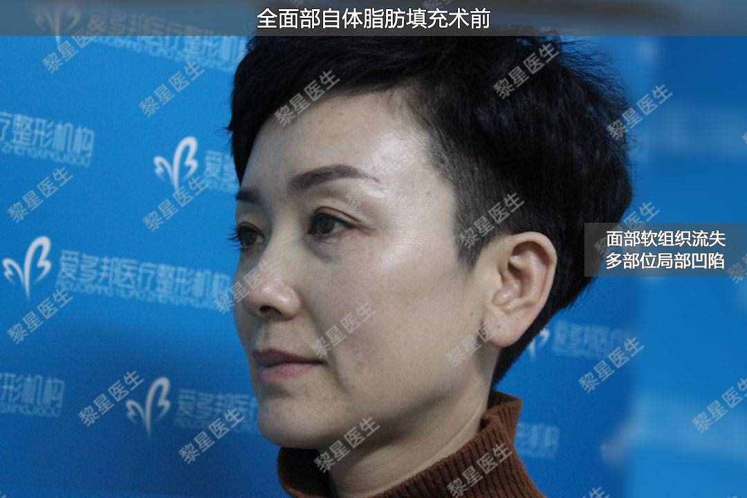 面部凹陷，皮膚松弛，像顆缺水的葡萄干，怎么辦？