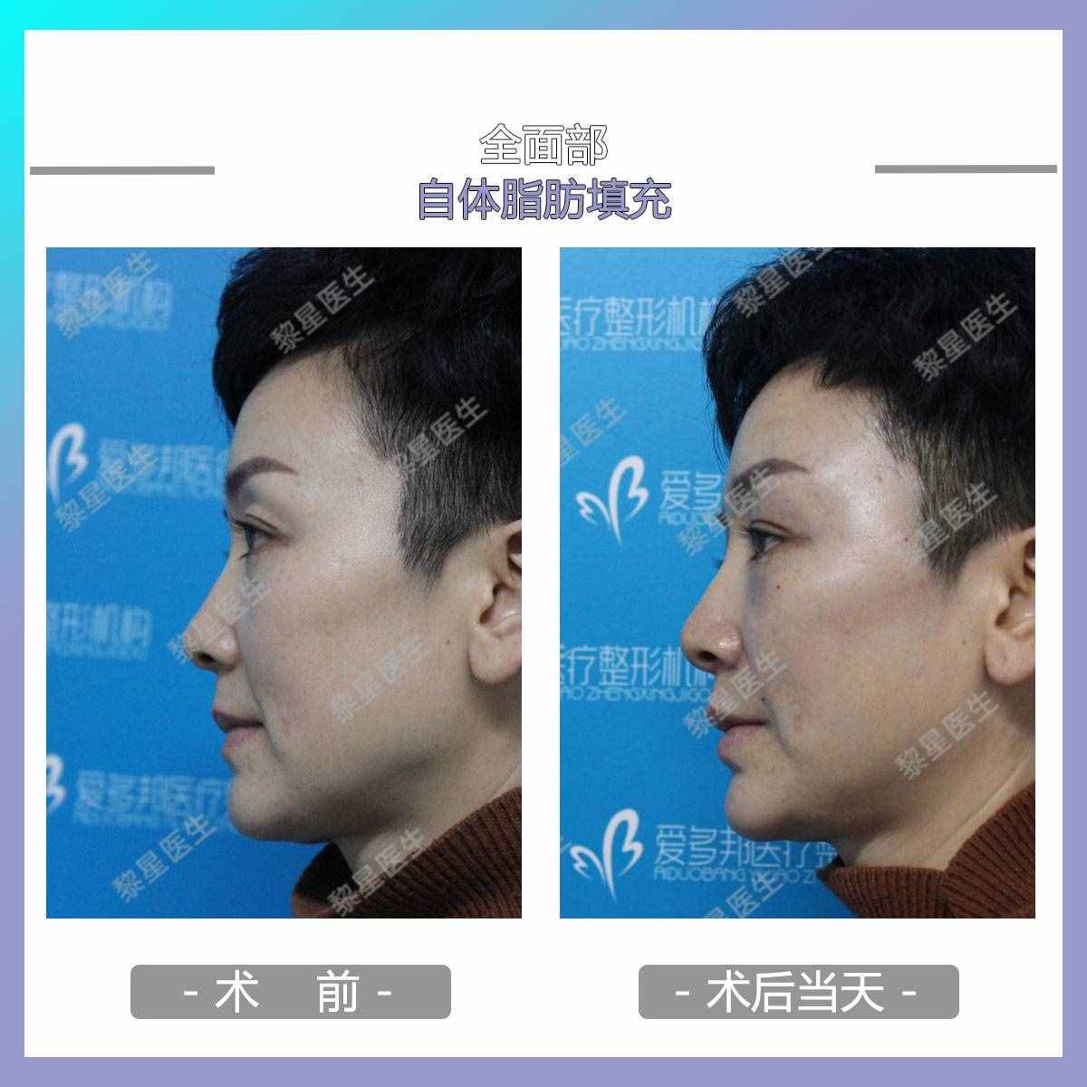 面部凹陷，皮膚松弛，像顆缺水的葡萄干，怎么辦？