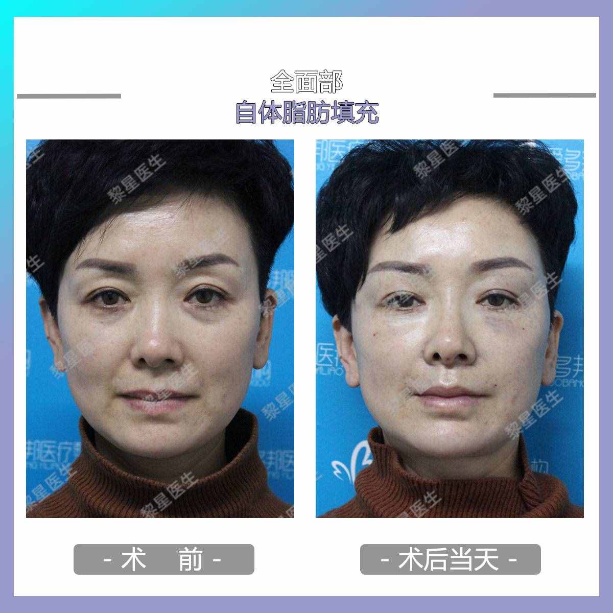 面部凹陷，皮膚松弛，像顆缺水的葡萄干，怎么辦？
