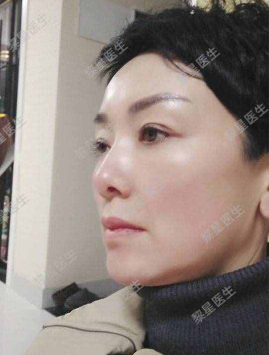 面部凹陷，皮膚松弛，像顆缺水的葡萄干，怎么辦？