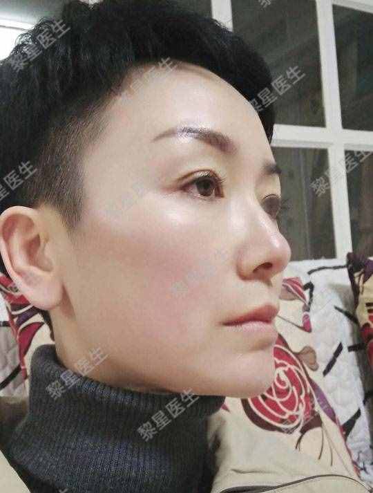 面部凹陷，皮膚松弛，像顆缺水的葡萄干，怎么辦？