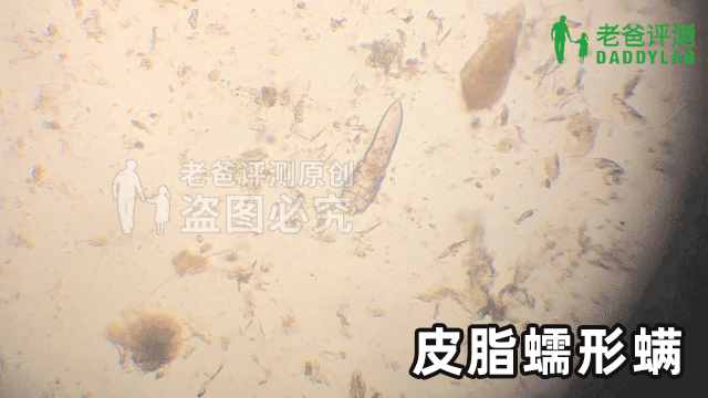 竟然在人臉上找到了螨蟲(chóng)，還在動(dòng)