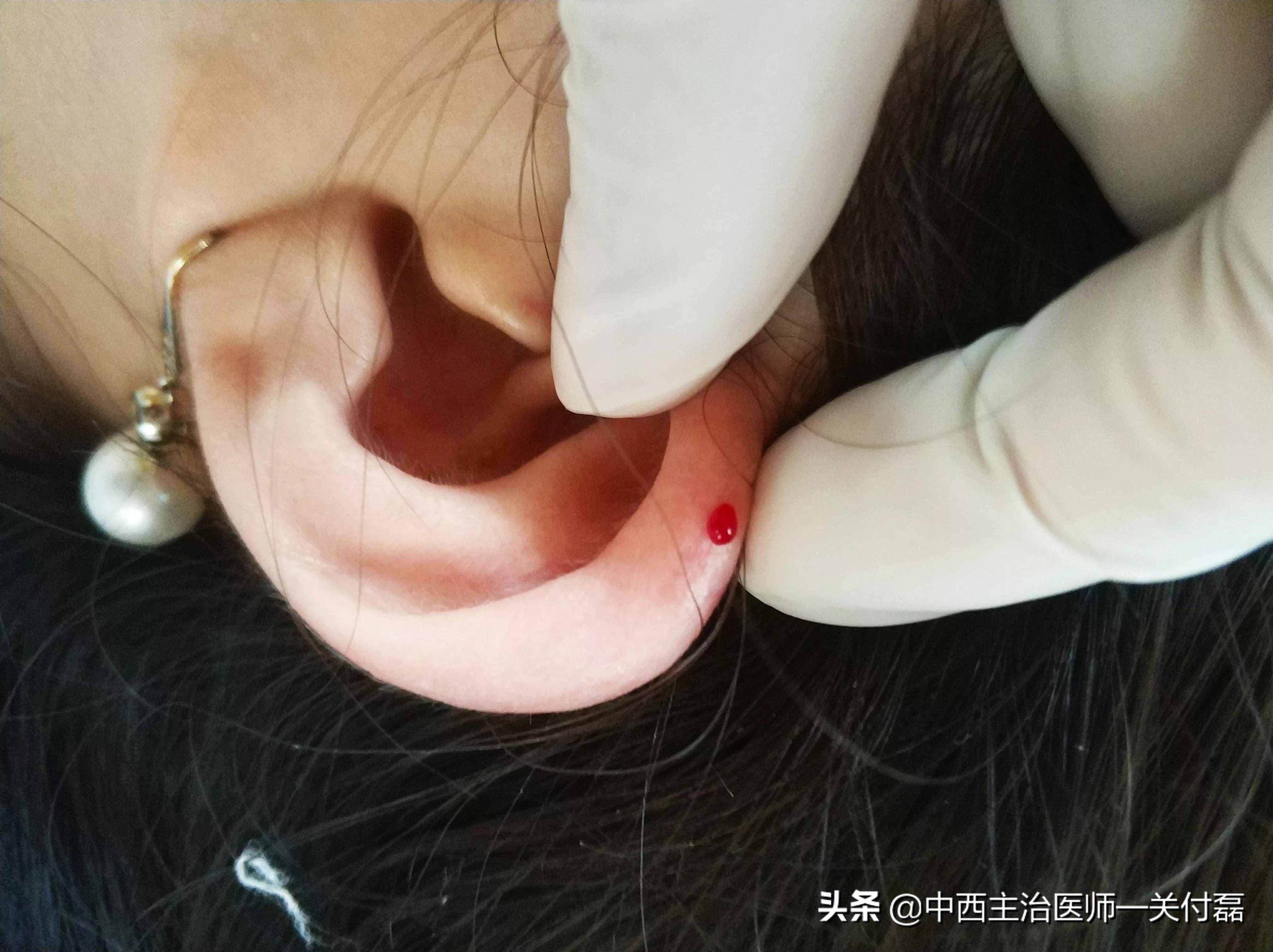 發(fā)燒、熱毒、皮膚瘡癢，中醫(yī)有個(gè)簡單有效的耳尖刺血療法