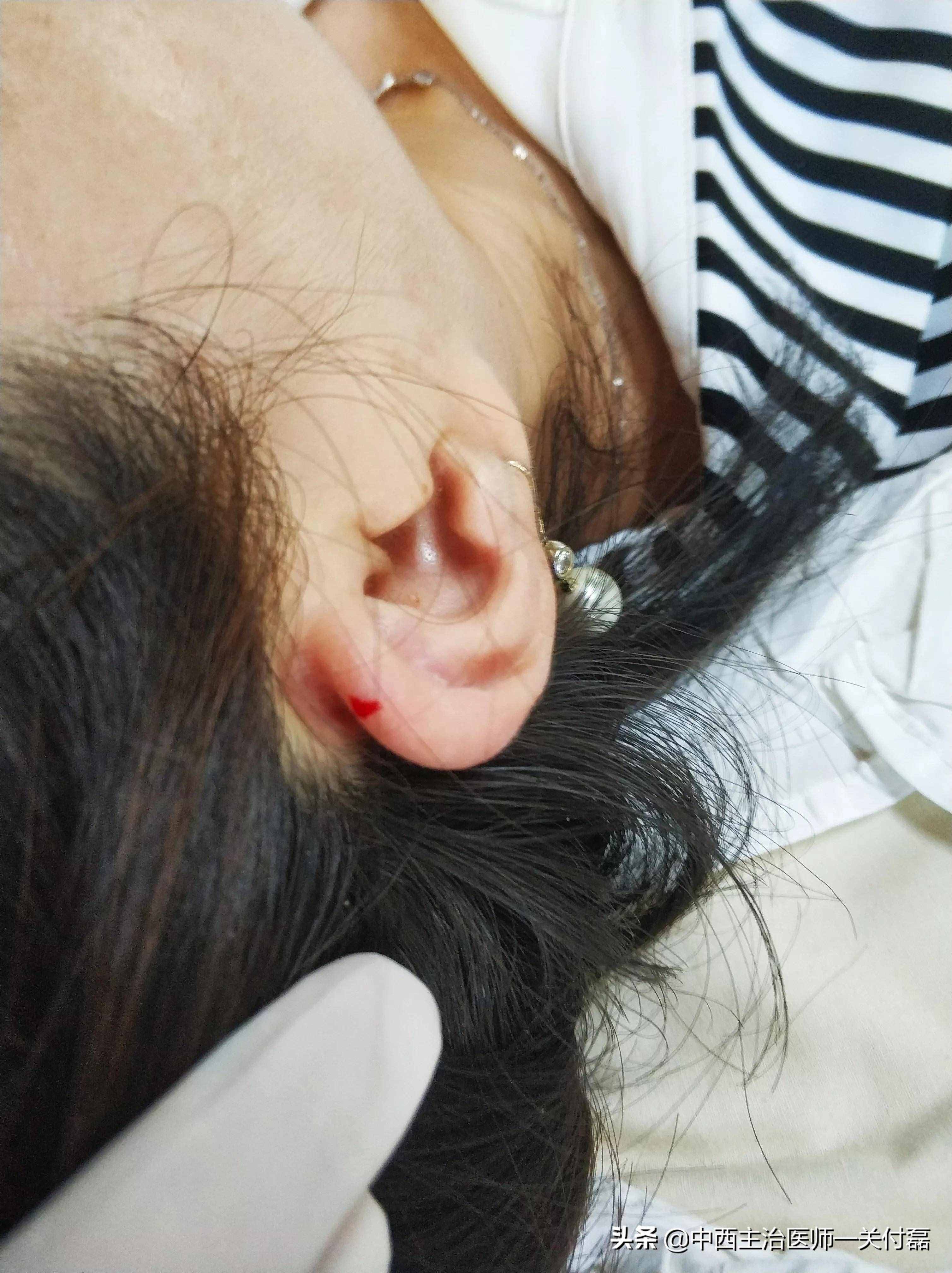 發(fā)燒、熱毒、皮膚瘡癢，中醫(yī)有個(gè)簡單有效的耳尖刺血療法