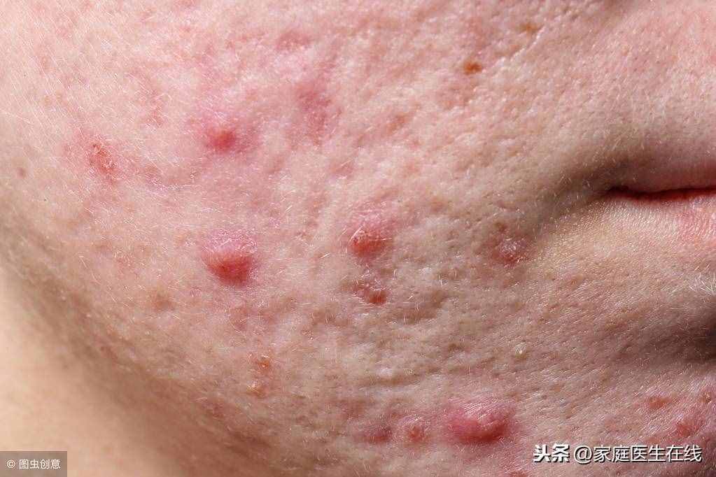 沒躲開5個原因，臉上會開始長痘痘，很難消掉