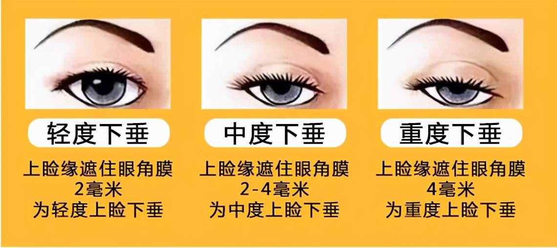為什么從小就有抬頭紋，眼睛還比別人??？