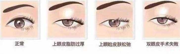 為什么從小就有抬頭紋，眼睛還比別人??？