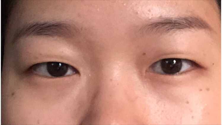 做個(gè)雙眼皮要花5w元錢？為什么別人幾百塊就行？醫(yī)生告訴您