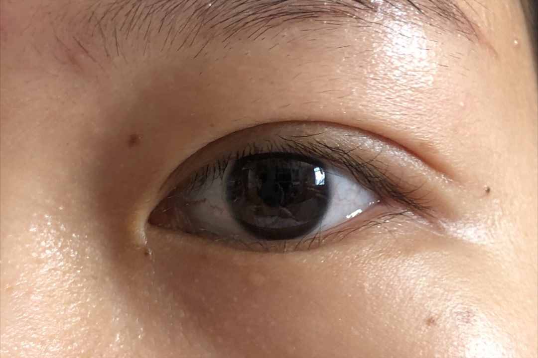 做個(gè)雙眼皮要花5w元錢？為什么別人幾百塊就行？醫(yī)生告訴您
