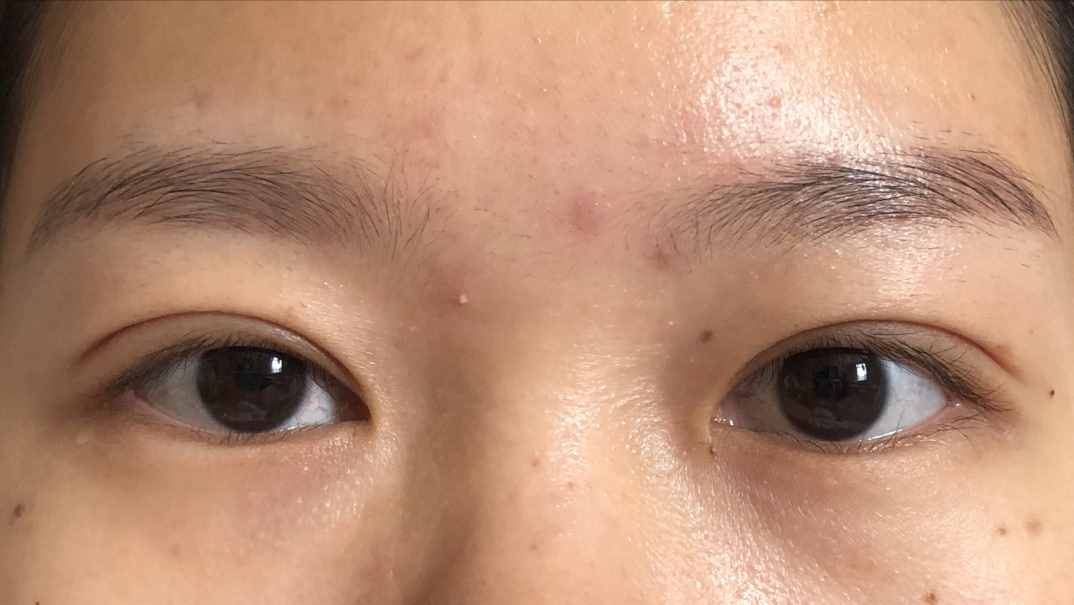 做個(gè)雙眼皮要花5w元錢？為什么別人幾百塊就行？醫(yī)生告訴您
