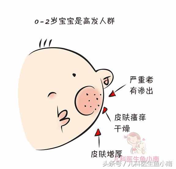 雖然只有一字之差，但寶寶濕疹熱疹大不同，醫(yī)生教辨別和護(hù)理方法