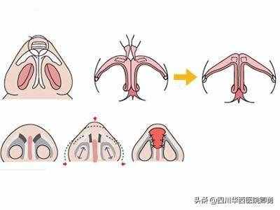 鼻翼縮小術三種常見方法
