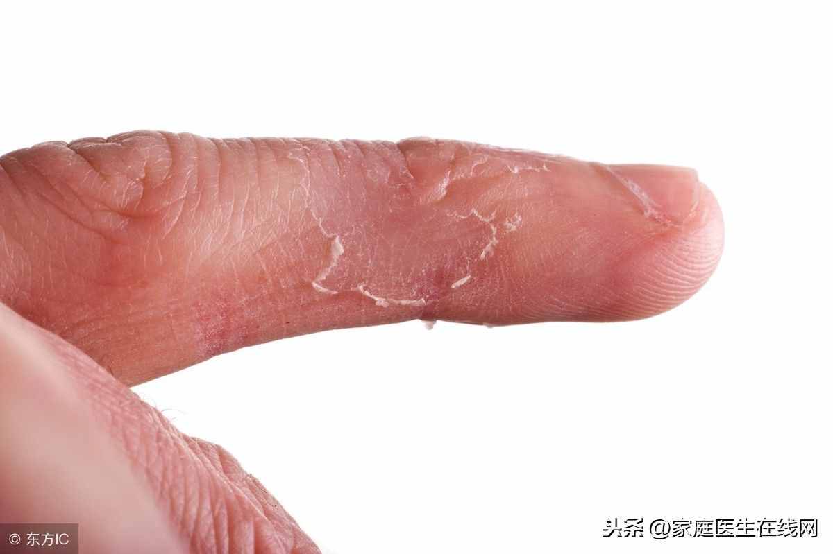 手脫皮是啥?。縿e再瞎猜了，大概有這3種可能性