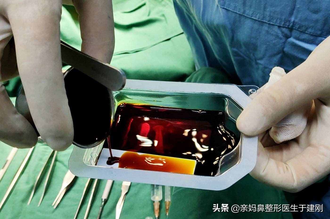 整形假體中膨體比硅膠更易感染？難取出？怎么還會有醫(yī)生使用？