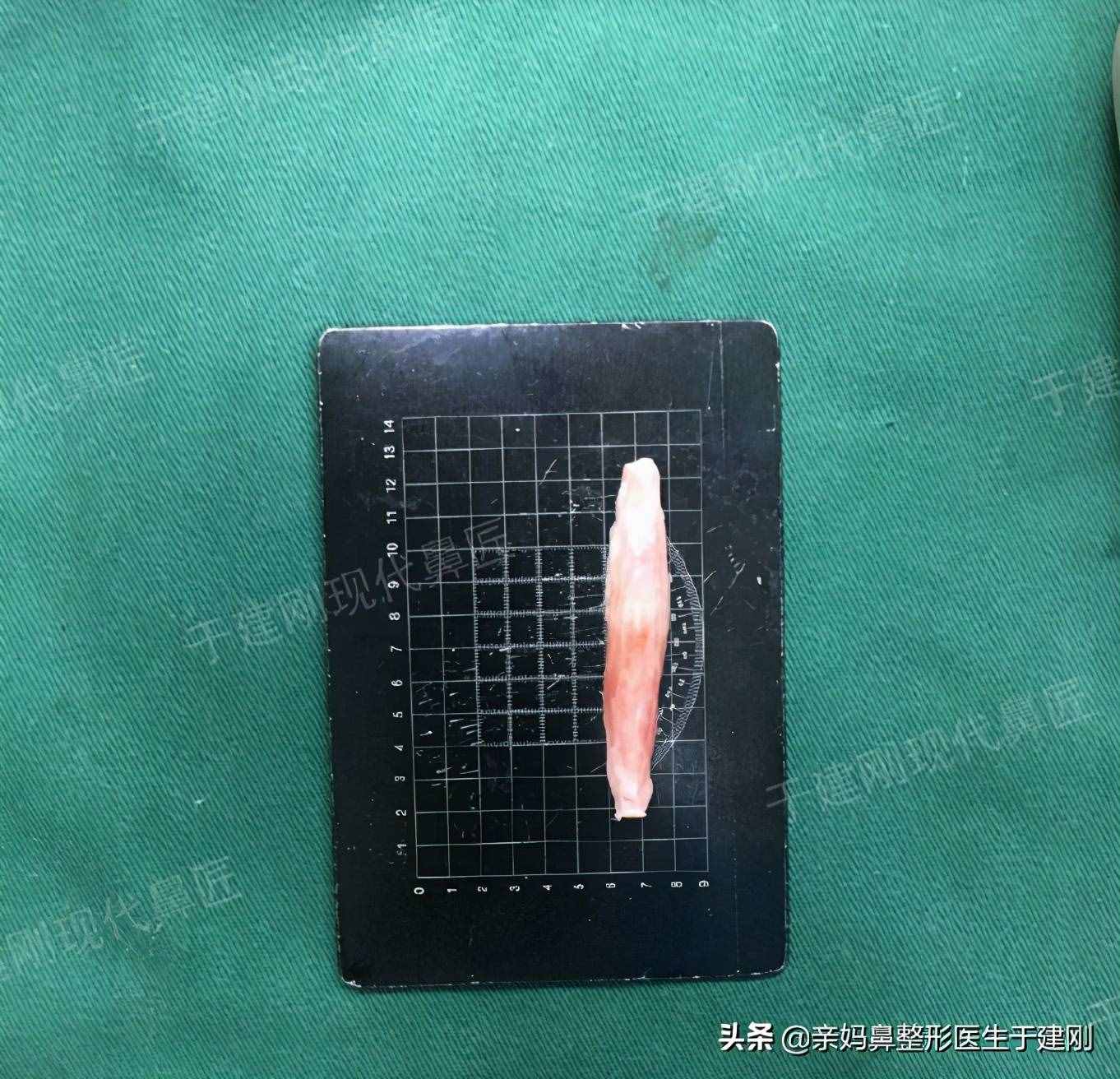 整形假體中膨體比硅膠更易感染？難取出？怎么還會有醫(yī)生使用？