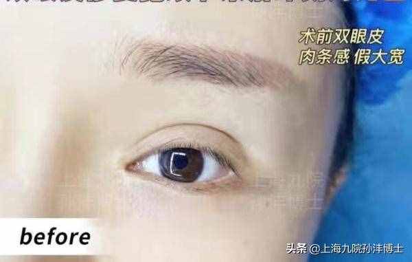 眼修復(fù)孫灃博士：全切雙眼皮修復(fù)是怎么做的呢？